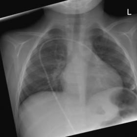 Chest X-ray AP and lateral views
