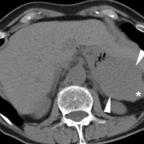 Unenhanced and post-contrast multidetector CT