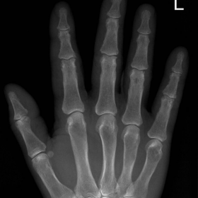 Radiograph of the hand, PA