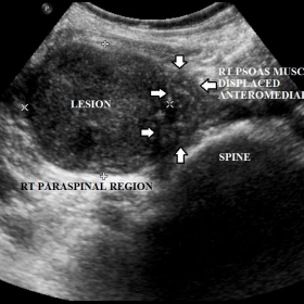 Ultrasound abdomen axial section just below the umbilicus