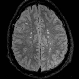 Head MRI - FLAIR