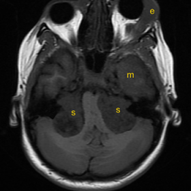 MRI T1WI (plain) axial & sagittal