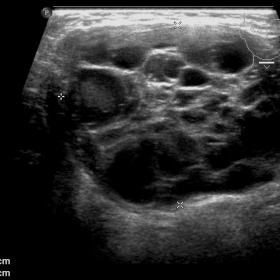Axial ultrasound of suprahyoid neck