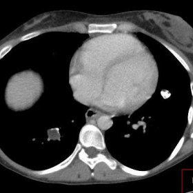 Chest CT: lung chondromas
