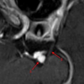3D T1-weighted vibe image after injection of gadolinium