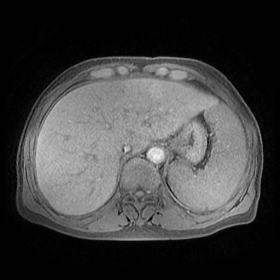 MRI non-contrast T1 fat saturation image