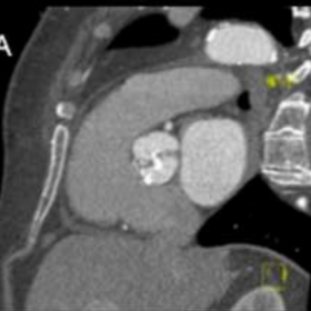 Bicuspid and calcified aortic valve