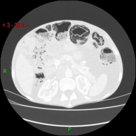 CT Abdomen - Lung Windows