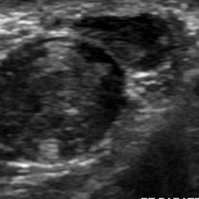 Sonography of the scrotum