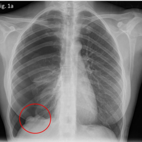 Posteroanterior chest radiography