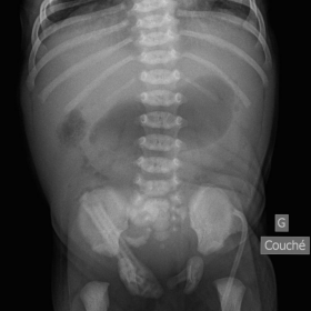 Abdomen X-ray