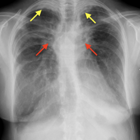 Conventional chest radiography