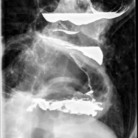 Achalasia with barium contrast and trapped air