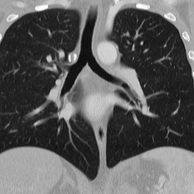 Pulmonary and aortic CT-angiography (CTA)