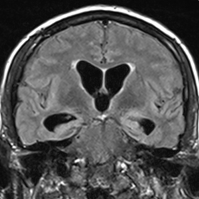 FLAIR, T2, pre and post-contrast T1 MRI brain