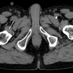Axial low-dose CT image acquired in conjunction with PET