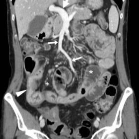 Preoperative post-contrast mutltidetector CT two years earlier