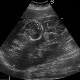 Upper abdominal ultrasound