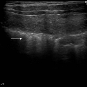 Supraclavicular ultrasound