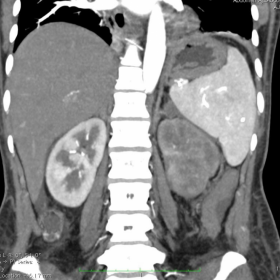 Infiltrated left kidney