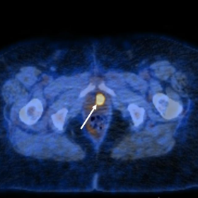 Axial fused PET/CT image