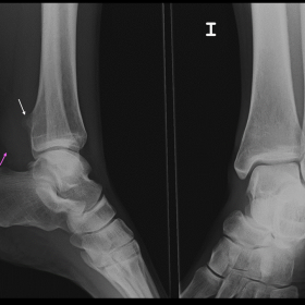 Lateral and AP radiographs of the ankle
