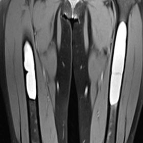 MRI both thighs, fat-suppressed T1WI, coronal