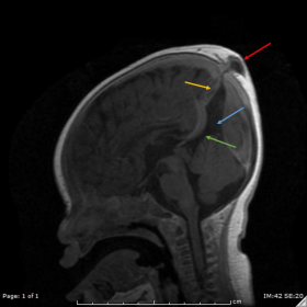 Sagittal T1-Weighted Post-Contrast MRI
