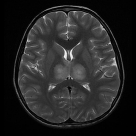 Axial T2W image