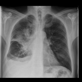 Thoracic X-ray and CT