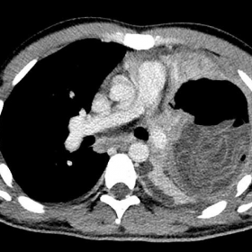 CT of the thorax - axial plane.