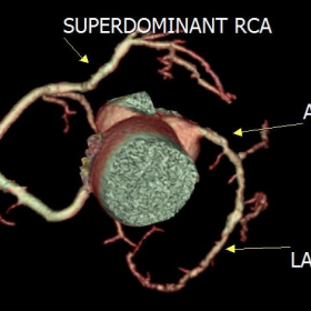 Case A: Absent left circumflex artery