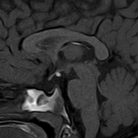 MRI of the pituitary gland