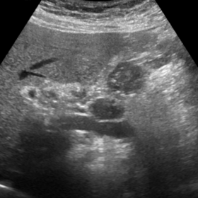 Ultrasound with colour doppler