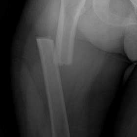 Displaced fracture of right femur
