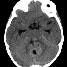 Noncontrast axial CT images