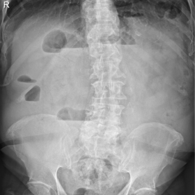 Upright abdominal radiograph