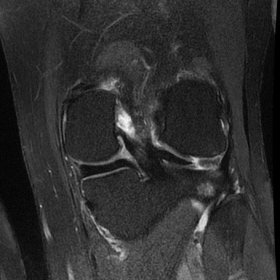Coronal SPAIR of the knee