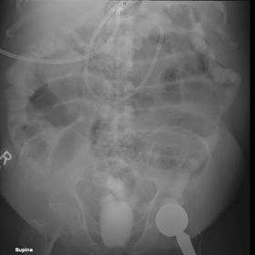 Plain X-ray abdomen supine and semi-sitting position