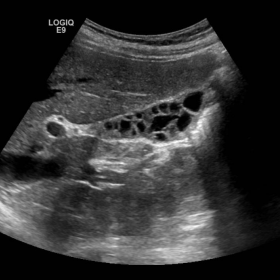 Ultrasound of the gallbladder.