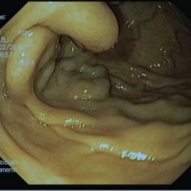 UGI endoscopy showing the gastric fundus lesion