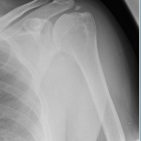 X-Ray of the left shoulder AP view
