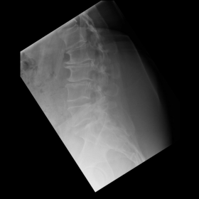 Lateral lumbosacral radiograph