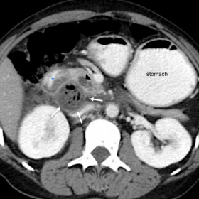 Axial contrast-enhanced CT image showing a perforated duodenal diverticulitis