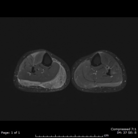 Axial STIR MRI of both legs