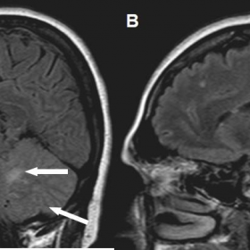 MRI BRAIN-FLAIR sagittal