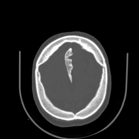 Falx cerebri ossification