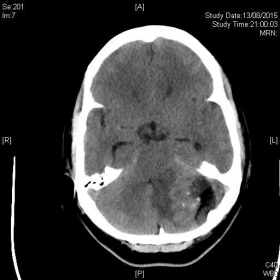 CT brain with left posterior cranial fossa mass