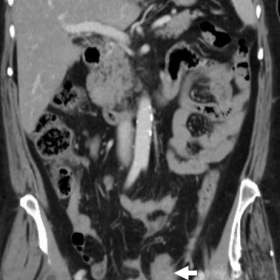 Initial contrast-enhanced multidetector CT before intravenous chemotherapy
