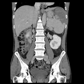 Fig. 1.a Splenic Infarction in coronal view